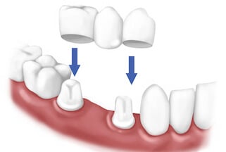 Answering Common Questions About Dental Bridge Damage