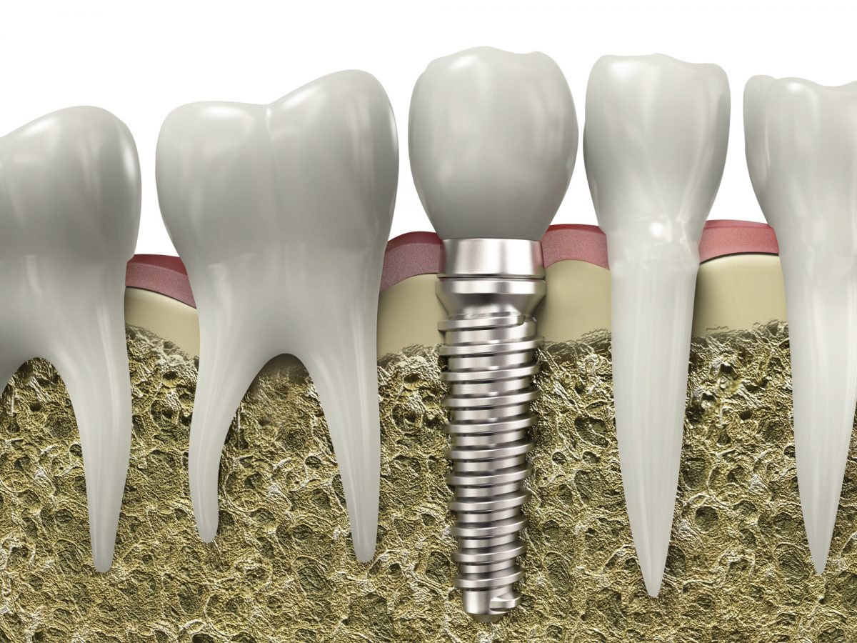 Why Patients Are Opting For Dental Implants