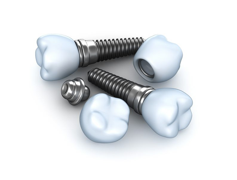 Dental Implants vs Dentures: Which Option Is Best for Your Smile?