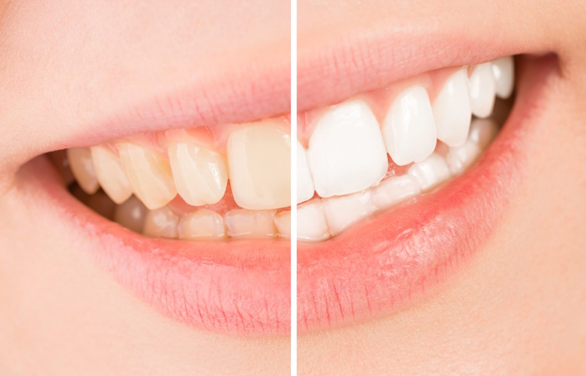 Understanding the Types of Teeth Whitening: Know Your Options