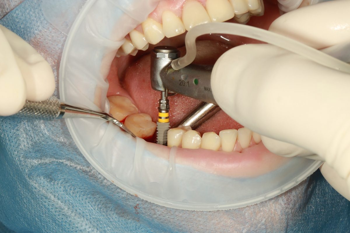 Dental Implants or Bridges: What Is the Better Choice?