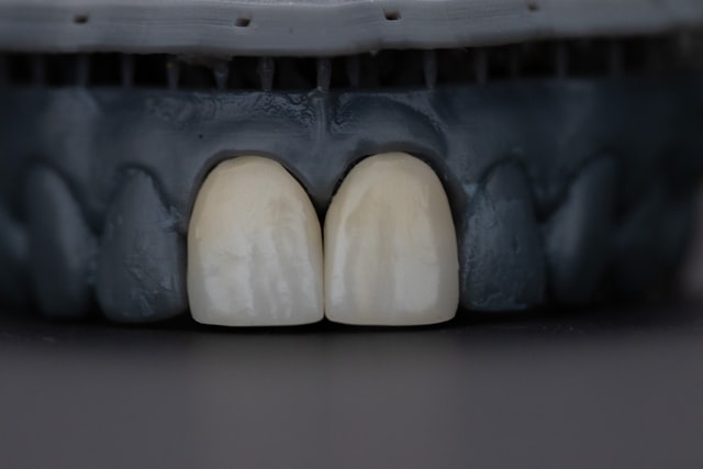 Crowns and Implants: Which One is the Right Choice?